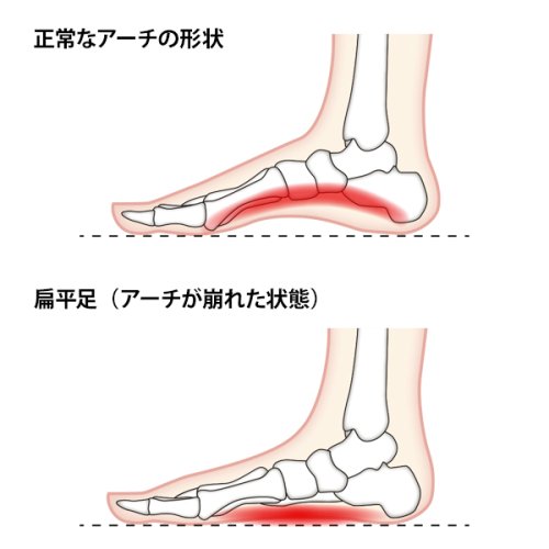 偏平足👣